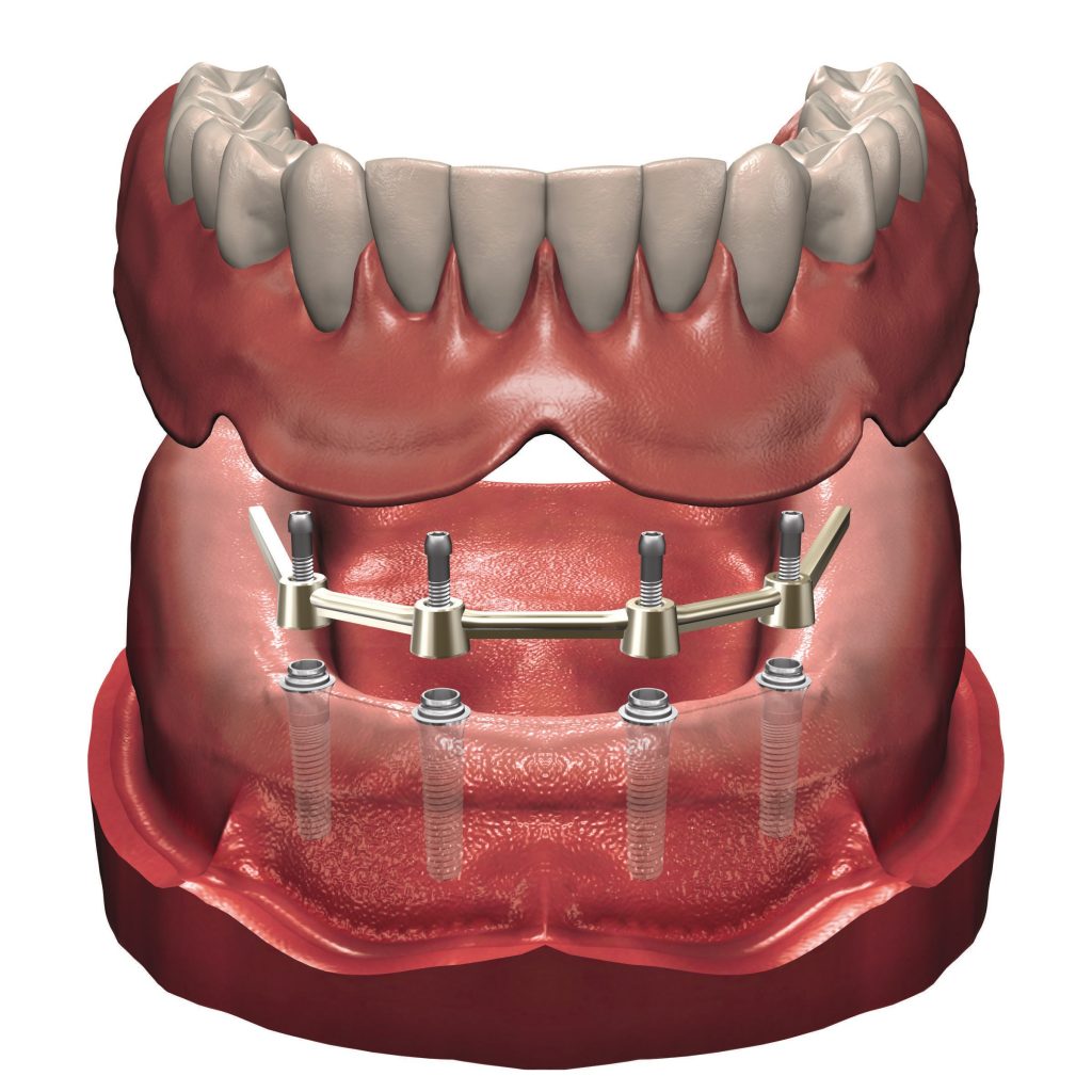 Implantes E Cirurgia Biodent